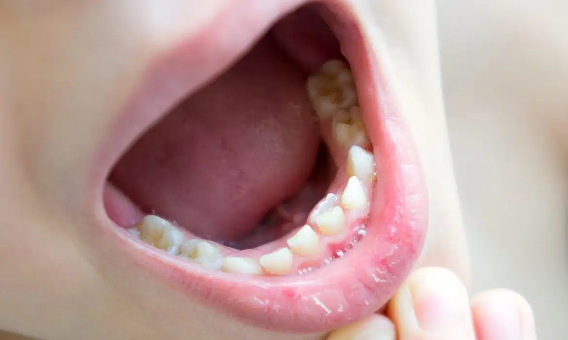 Les solutions novatrices pour corriger l’alignement de vos dents
