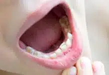 Les solutions novatrices pour corriger l’alignement de vos dents