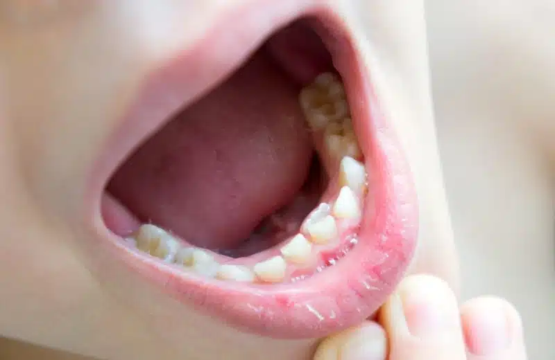 Les solutions novatrices pour corriger l’alignement de vos dents