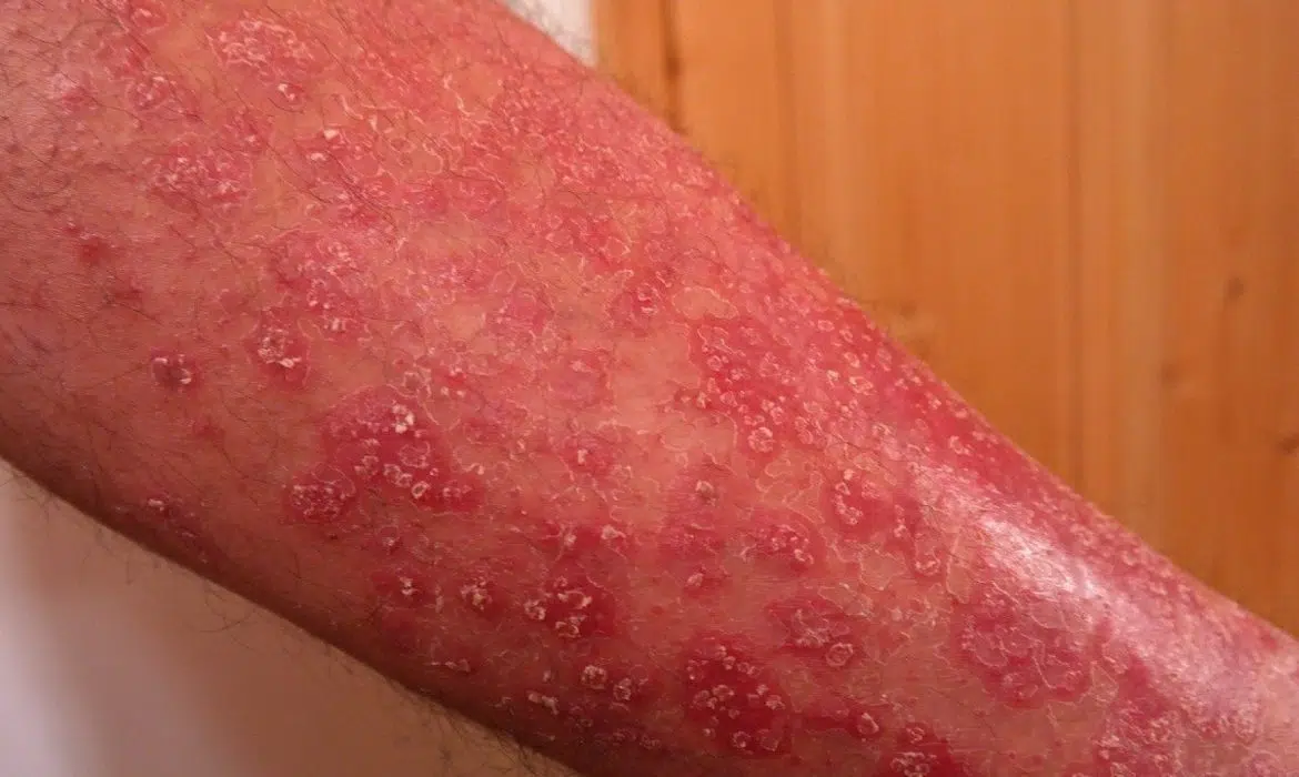 4 remèdes naturels contre le psoriasis