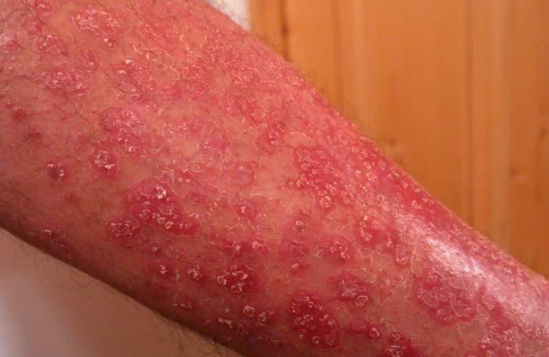 4 remèdes naturels contre le psoriasis