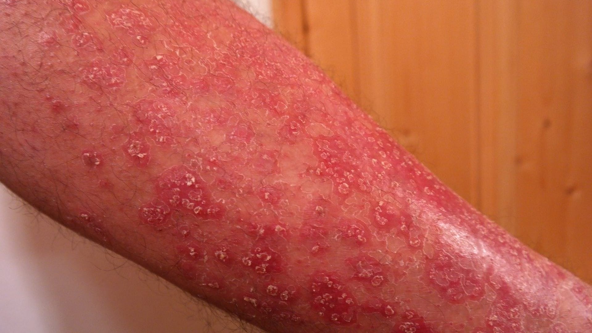 4 remèdes naturels contre le psoriasis