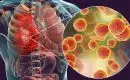 Comment guérir une infection pulmonaire naturellement ?