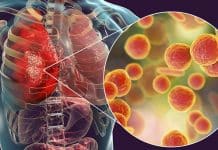 Comment guérir une infection pulmonaire naturellement ?