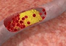 Quelles plantes homéopathiques pour abaisser le cholestérol ?