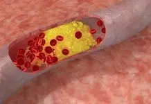 Quelles plantes homéopathiques pour abaisser le cholestérol ?