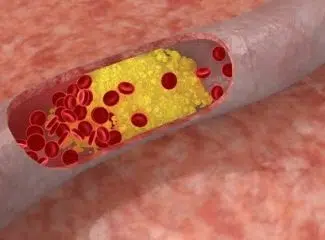 Quelles plantes homéopathiques pour abaisser le cholestérol ?
