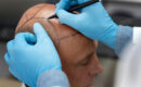 Les innovations dans le traitement de la perte de cheveux : focus sur les injections prp