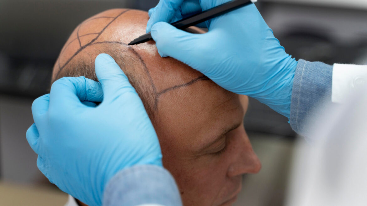 Les innovations dans le traitement de la perte de cheveux : focus sur les injections prp