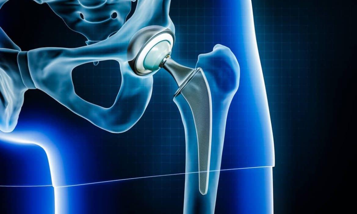 Comment savoir si vous devez envisager une prothèse de la hanche ?