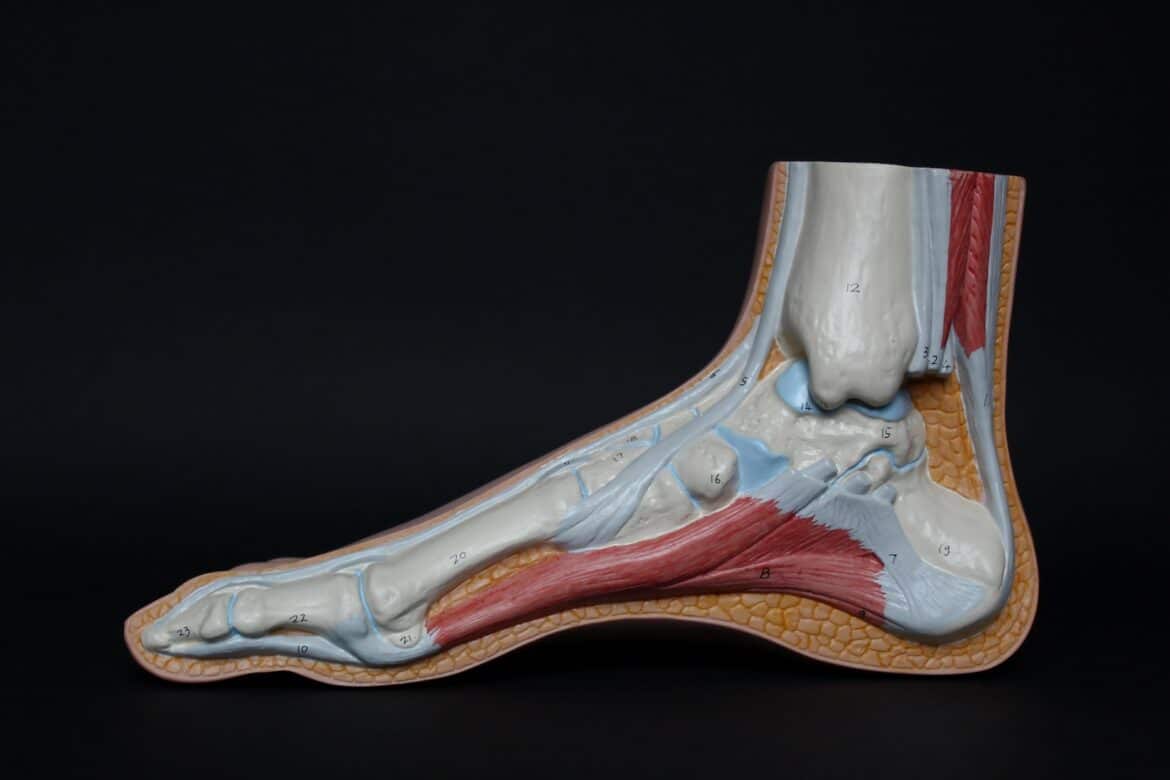 arthrose