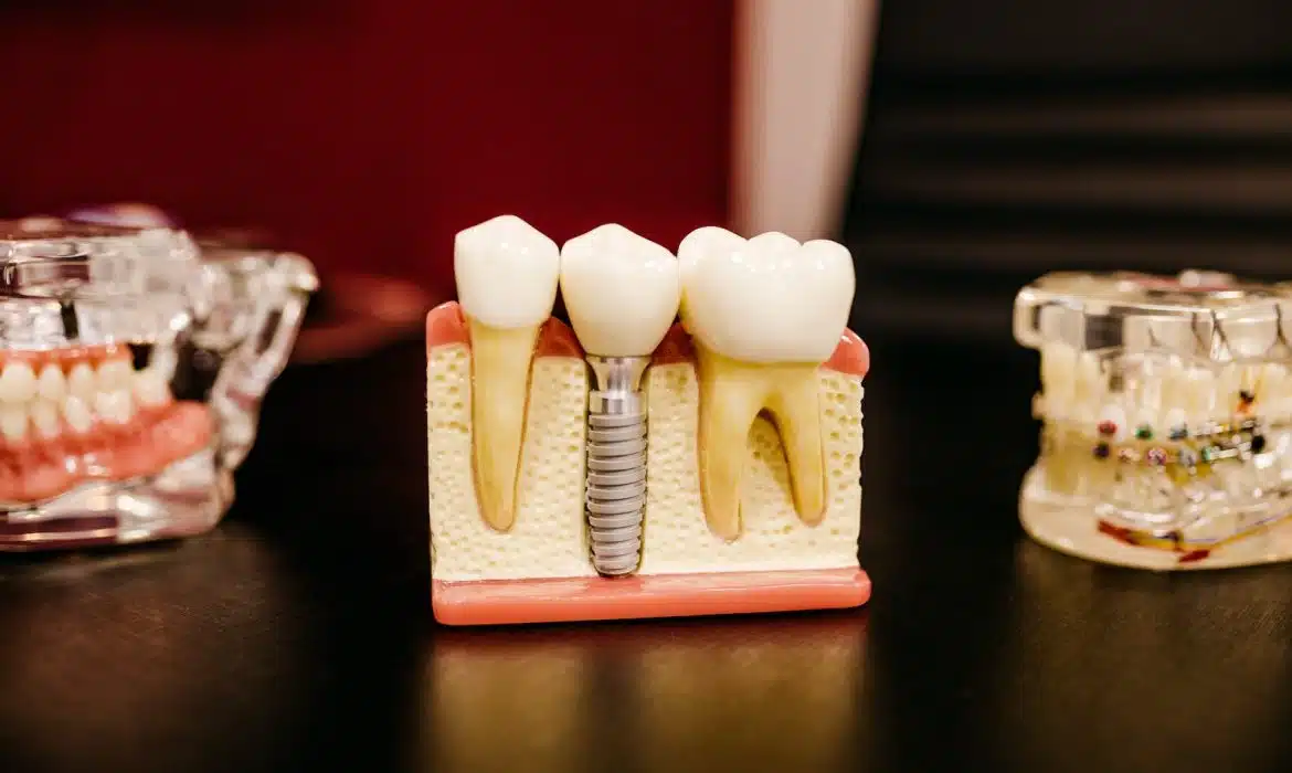 Implant dentaire : comment bien choisir le spécialiste ?  